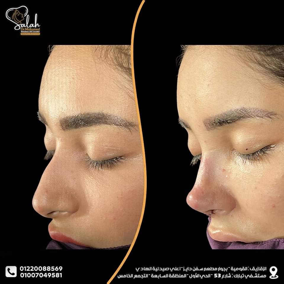 Piezo Rhinoplasty