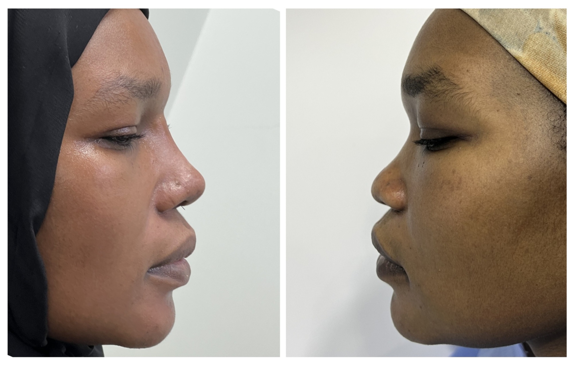 Saddle Nose Rhinoplasty