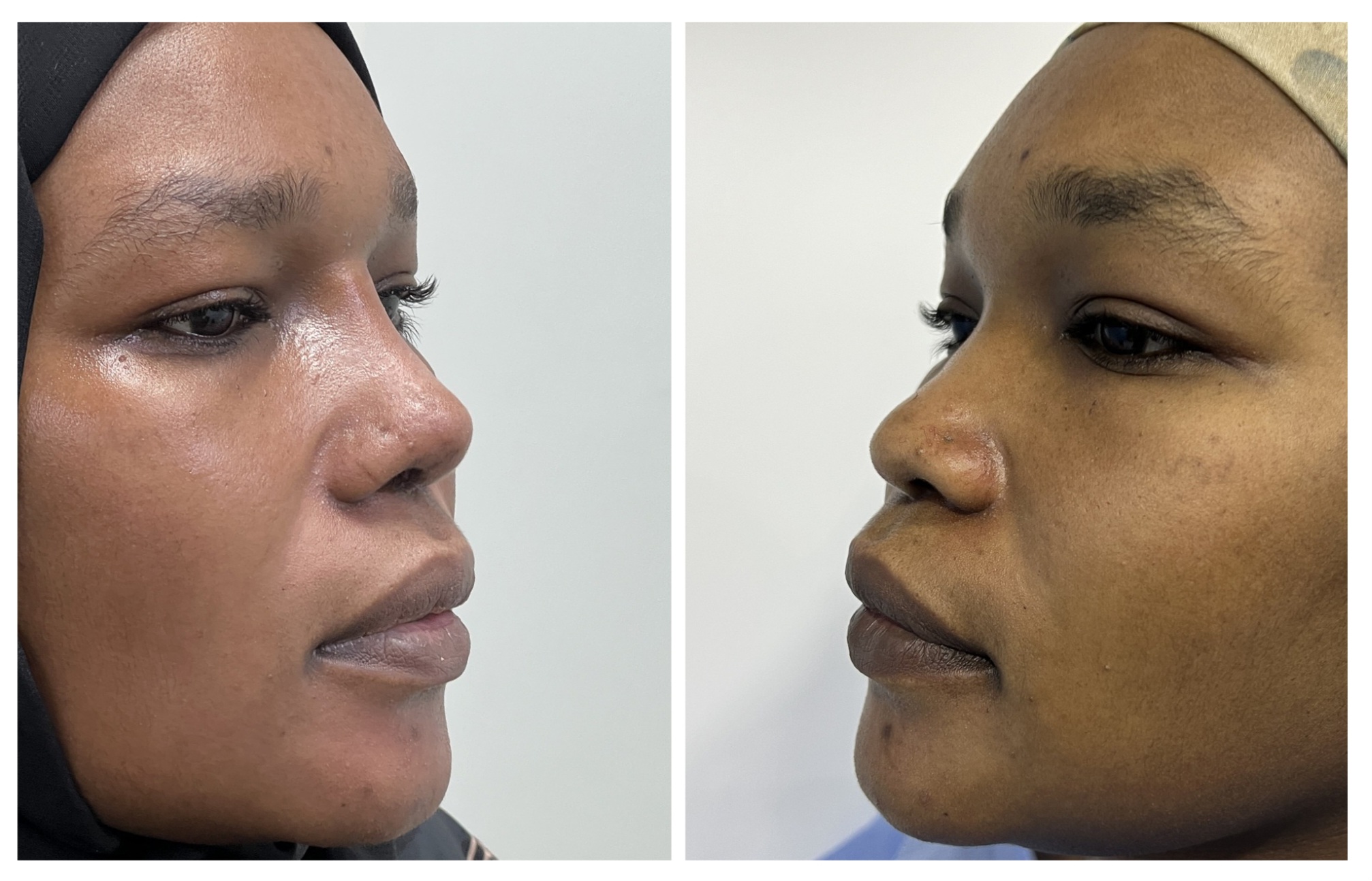 Saddle Nose Rhinoplasty